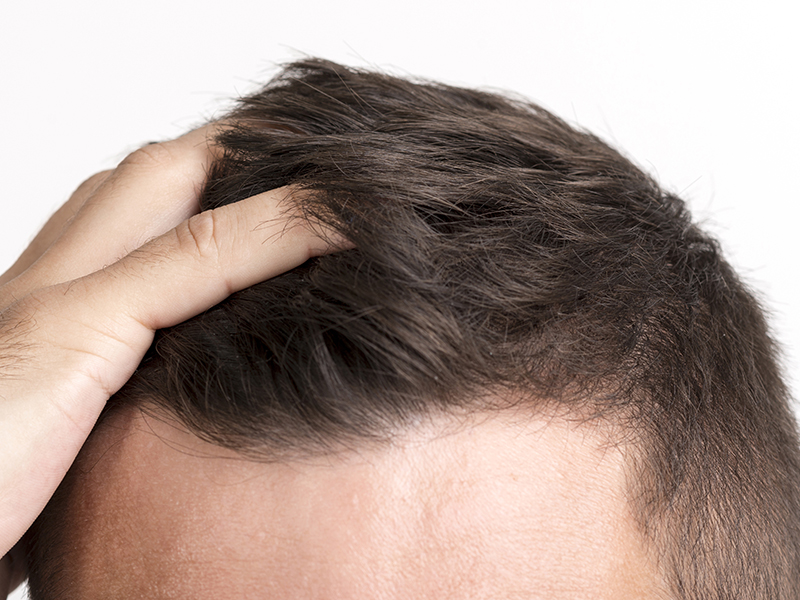 Opadanje kose kod muškaraca