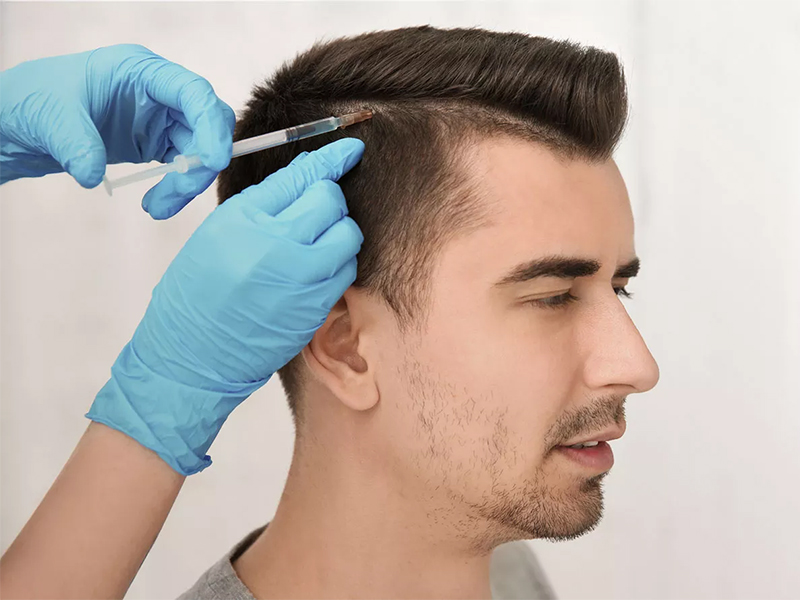 Da li je transplantacija kose dobra ideja ?